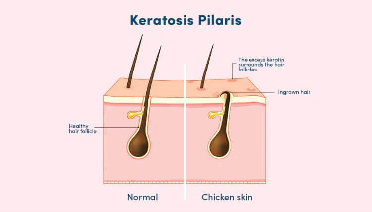 keratosis pilaris skin